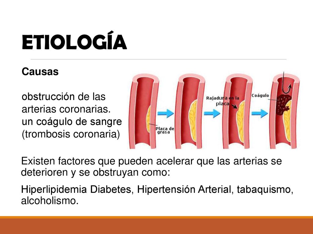 ETIOLOGÍA Causas obstrucción de las arterias coronarias.