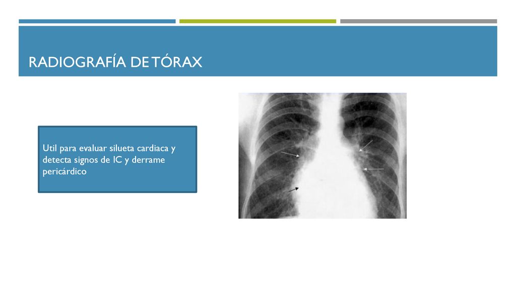 Radiografía de tórax Util para evaluar silueta cardiaca y detecta signos de IC y derrame pericárdico.