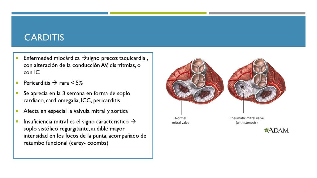 Carditis Enfermedad miocárdica signo precoz taquicardia , con alteración de la conducción AV, disrritmias, o con IC.