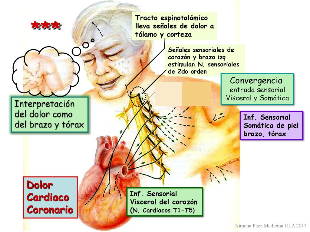 *** Dolor Cardiaco Coronario Convergencia Interpretación