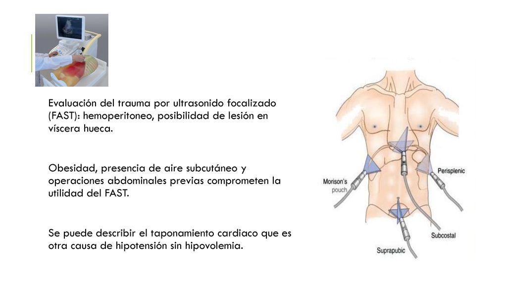Evaluación del trauma por ultrasonido focalizado (FAST): hemoperitoneo, posibilidad de lesión en víscera hueca.