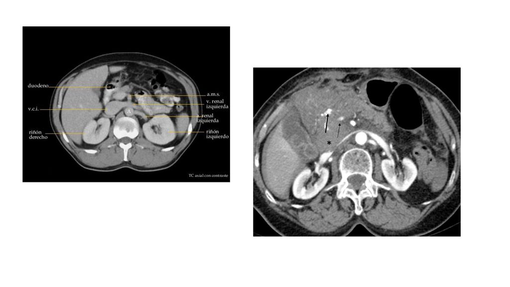 Tac 2 paciente con herida penetrante abdominal que presentó hematoma pancreático (*) con focos de sangrado activo (flecha) y hemoperitoneo