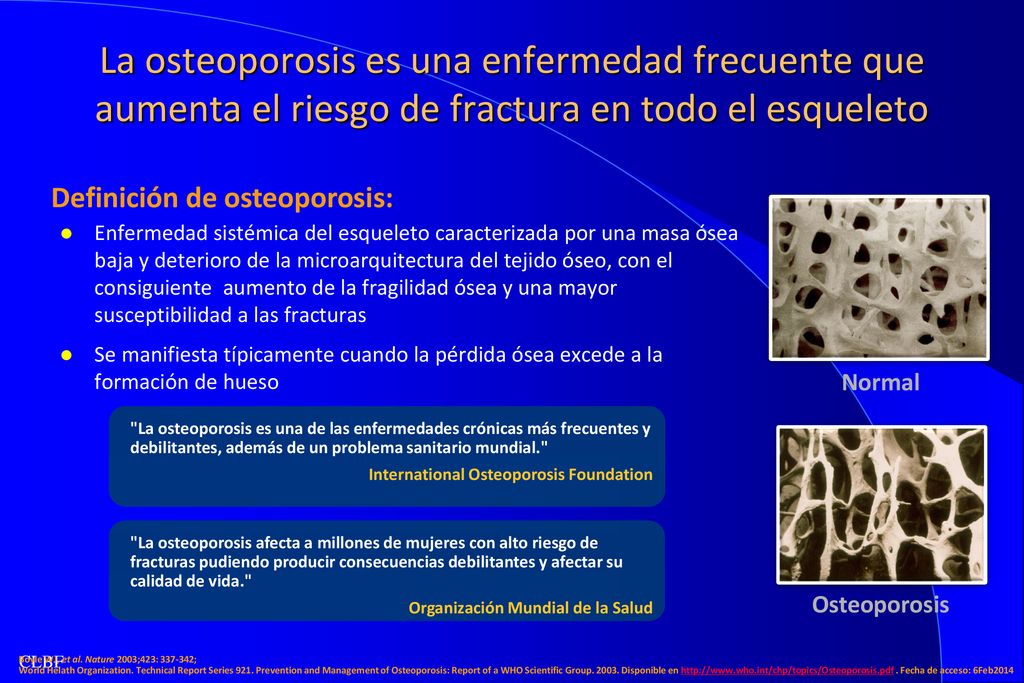 La osteoporosis es una enfermedad frecuente que aumenta el riesgo de fractura en todo el esqueleto