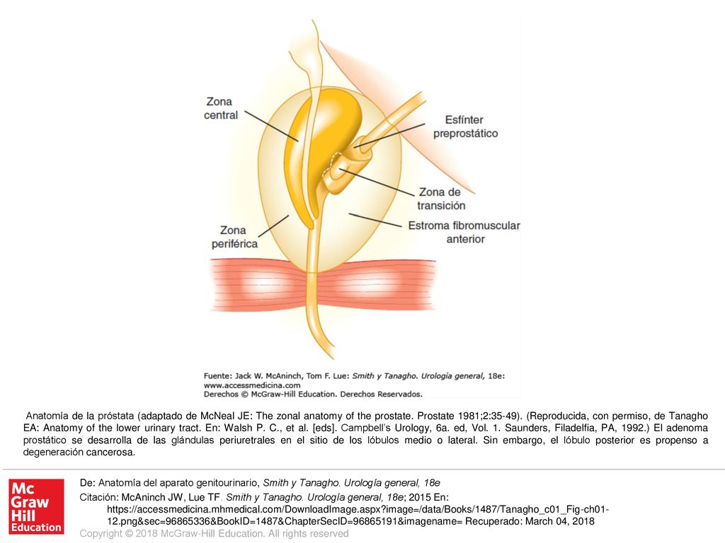 Anatomía de la próstata (adaptado de McNeal JE: The zonal anatomy of the prostate. Prostate 1981;2:35-49). (Reproducida, con permiso, de Tanagho EA: Anatomy of the lower urinary tract. En: Walsh P. C., et al. [eds]. Campbell’s Urology, 6a. ed, Vol. 1. Saunders, Filadelfia, PA, 1992.) El adenoma prostático se desarrolla de las glándulas periuretrales en el sitio de los lóbulos medio o lateral. Sin embargo, el lóbulo posterior es propenso a degeneración cancerosa.