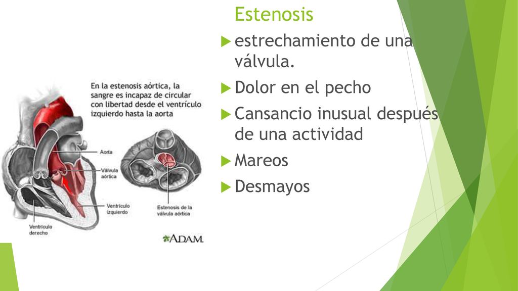 Estenosis estrechamiento de una válvula. Dolor en el pecho