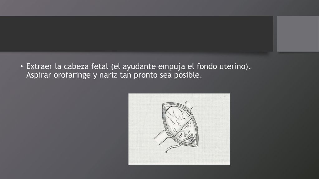 Extraer la cabeza fetal (el ayudante empuja el fondo uterino)