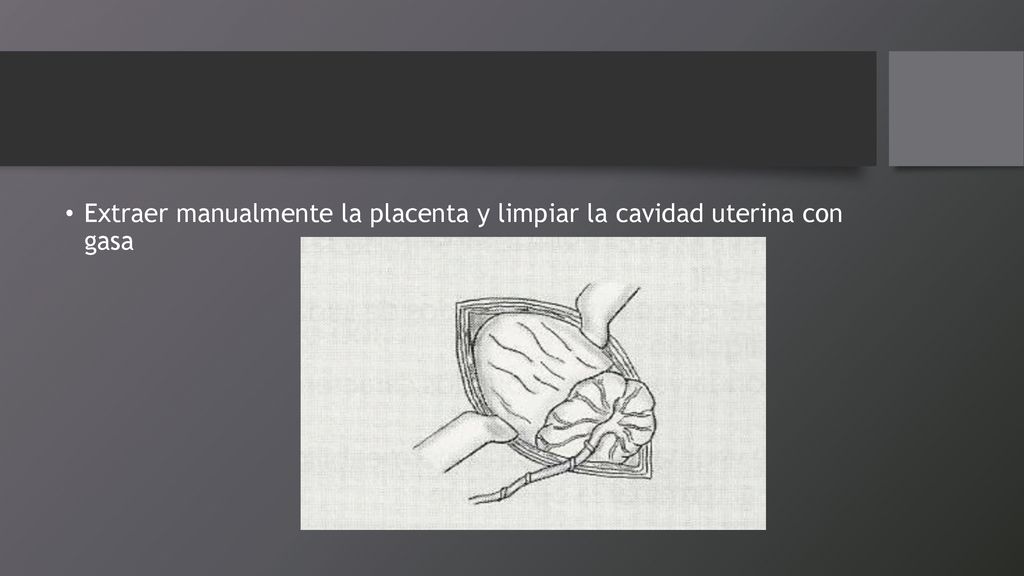 Extraer manualmente la placenta y limpiar la cavidad uterina con gasa