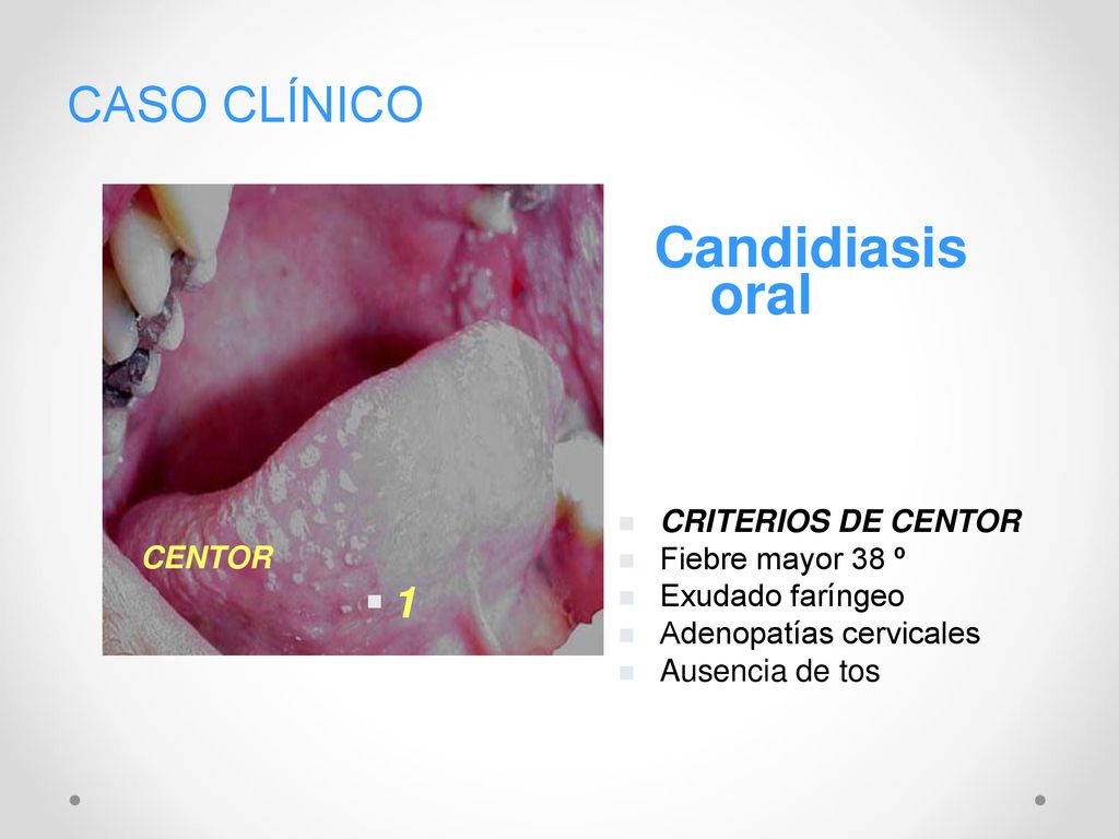 Candidiasis oral CASO CLÍNICO 1 CRITERIOS DE CENTOR Fiebre mayor 38 º