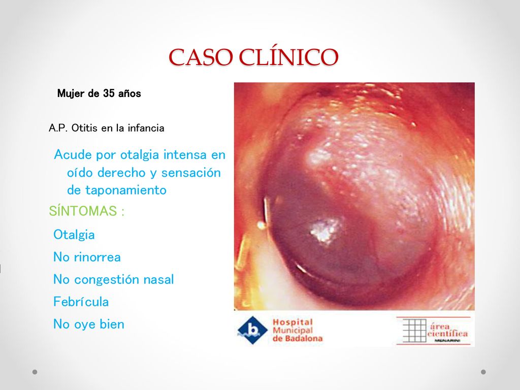 CASO CLÍNICO Mujer de 35 años. A.P. Otitis en la infancia. Acude por otalgia intensa en oído derecho y sensación de taponamiento.