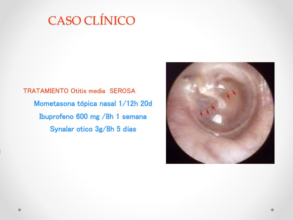 Mometasona tópica nasal 1/12h 20d Ibuprofeno 600 mg /8h 1 semana