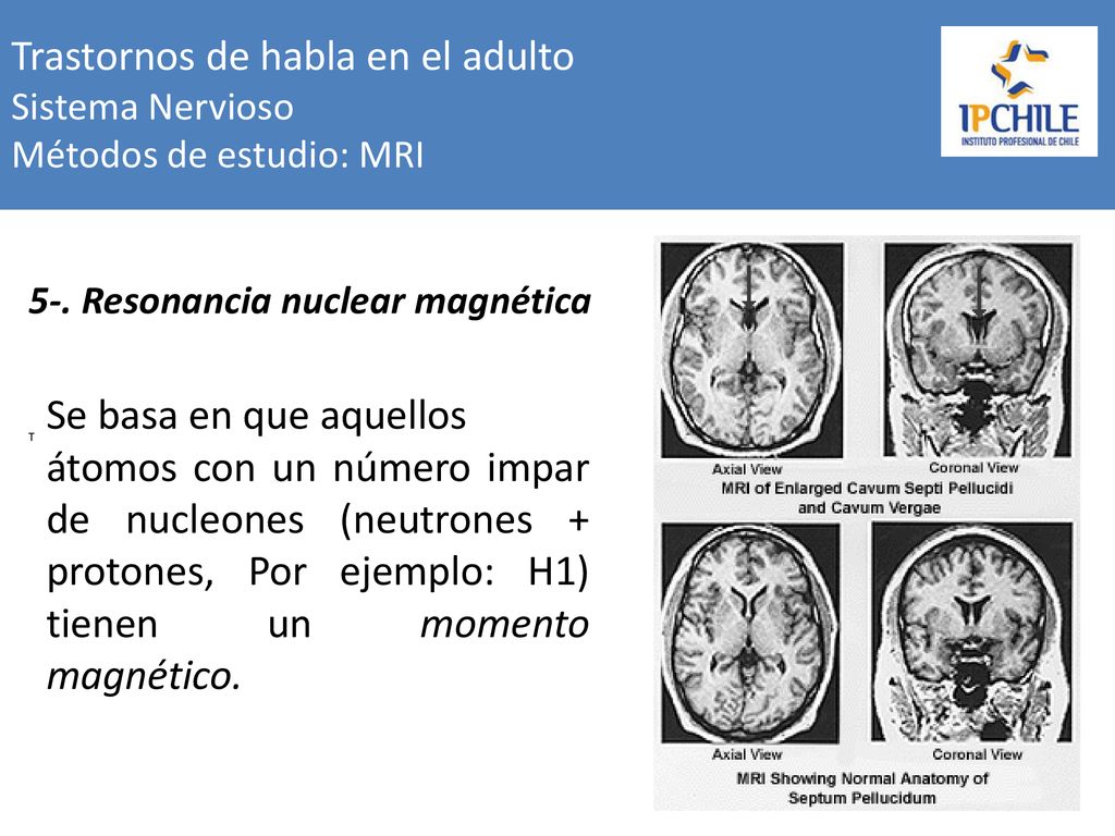 Trastornos de habla en el adulto Sistema Nervioso Métodos de estudio: MRI