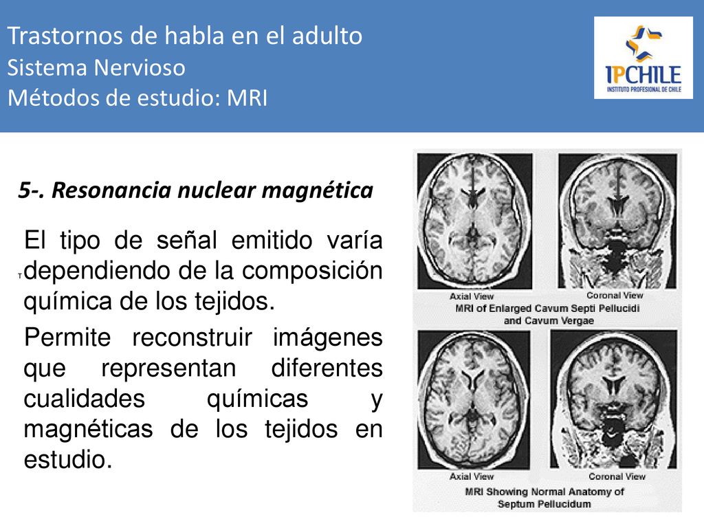 Trastornos de habla en el adulto Sistema Nervioso Métodos de estudio: MRI