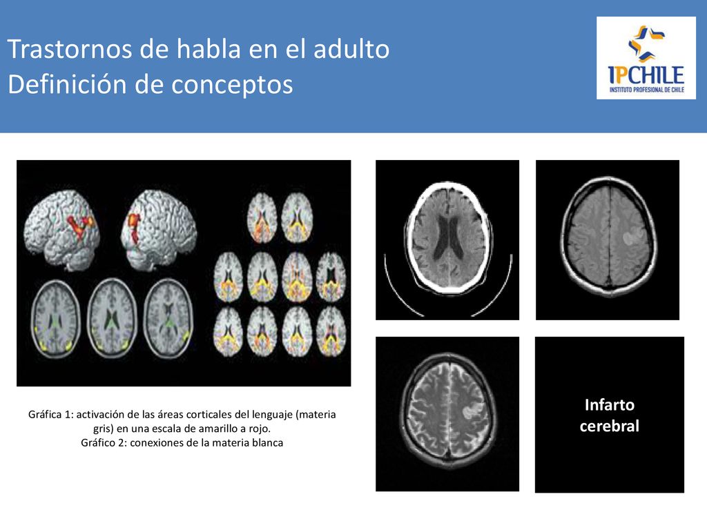 Trastornos de habla en el adulto Definición de conceptos
