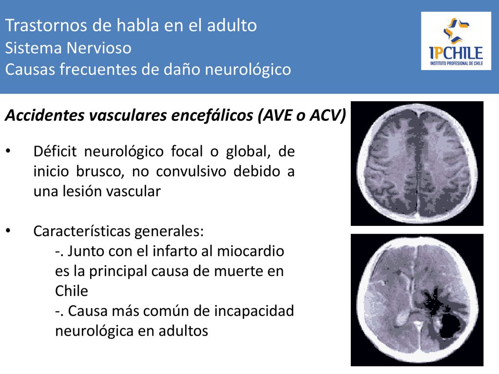 Trastornos de habla en el adulto Sistema Nervioso Causas frecuentes de daño neurológico