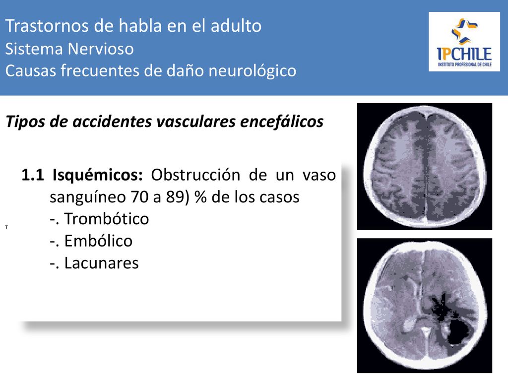 Trastornos de habla en el adulto Sistema Nervioso Causas frecuentes de daño neurológico