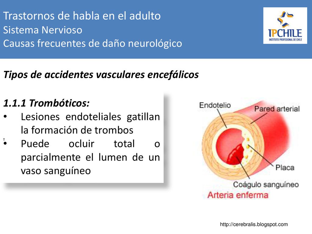 Trastornos de habla en el adulto Sistema Nervioso Causas frecuentes de daño neurológico