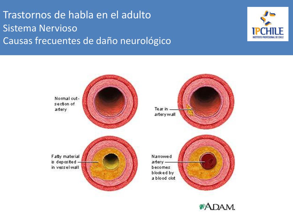 Trastornos de habla en el adulto Sistema Nervioso Causas frecuentes de daño neurológico
