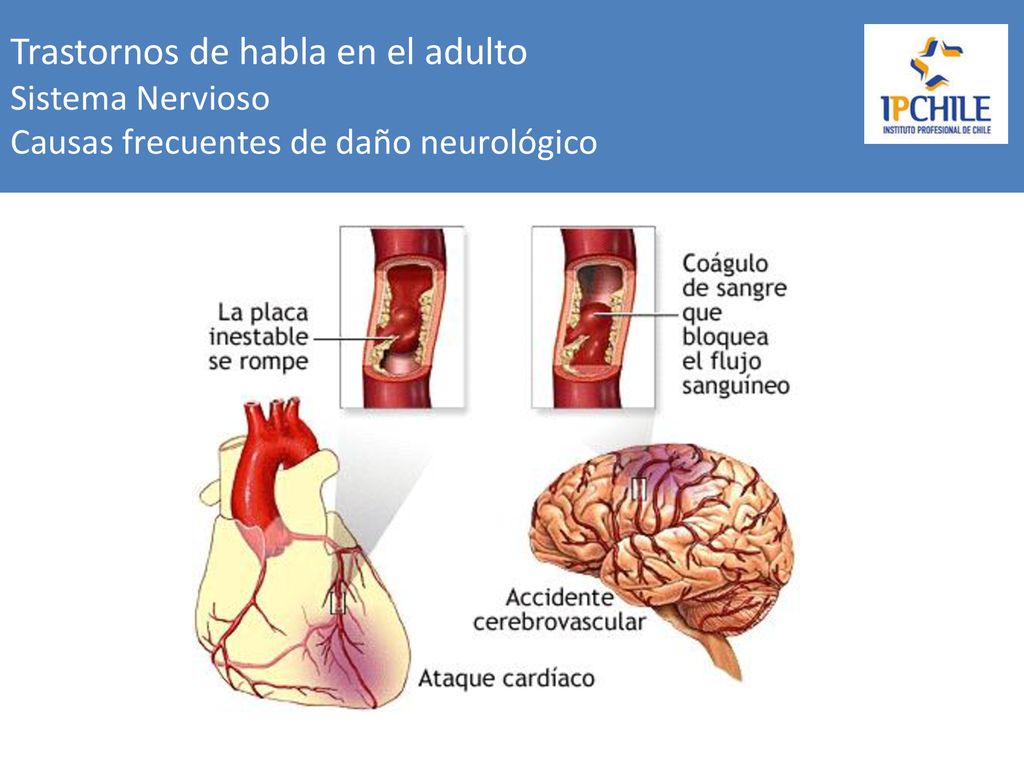 Trastornos de habla en el adulto Sistema Nervioso Causas frecuentes de daño neurológico