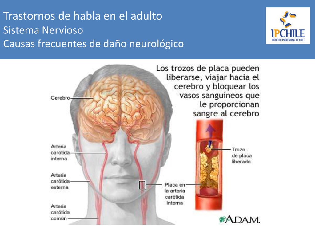 Trastornos de habla en el adulto Sistema Nervioso Causas frecuentes de daño neurológico