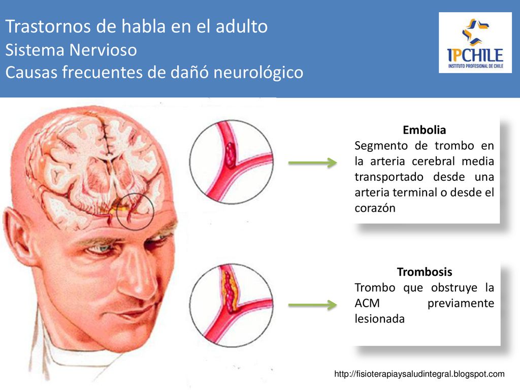 Trastornos de habla en el adulto Sistema Nervioso Causas frecuentes de dañó neurológico