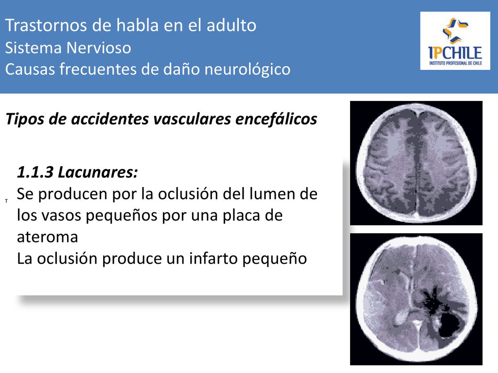 Trastornos de habla en el adulto Sistema Nervioso Causas frecuentes de daño neurológico