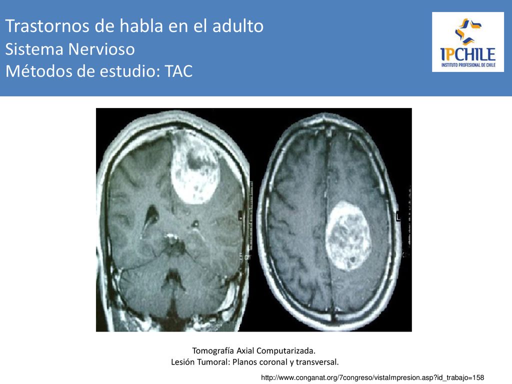 Trastornos de habla en el adulto Sistema Nervioso Métodos de estudio: TAC