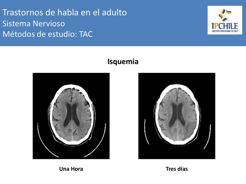 Trastornos de habla en el adulto Sistema Nervioso Métodos de estudio: TAC