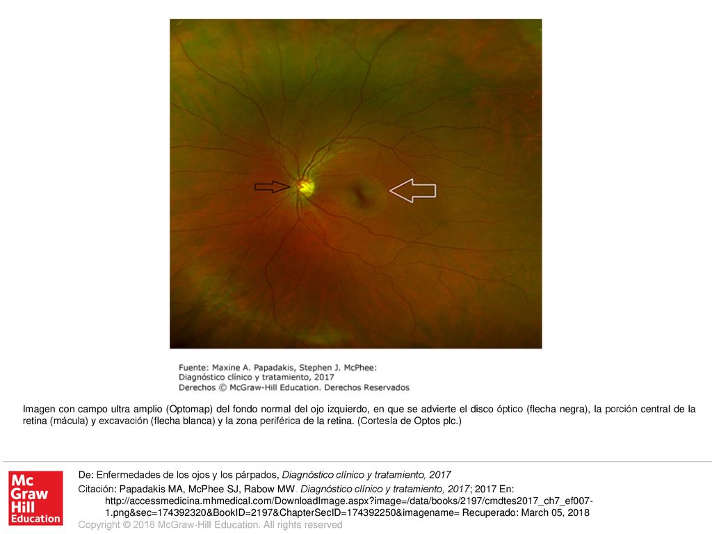 Imagen con campo ultra amplio (Optomap) del fondo normal del ojo izquierdo, en que se advierte el disco óptico (flecha negra), la porción central de la retina (mácula) y excavación (flecha blanca) y la zona periférica de la retina. (Cortesía de Optos plc.)