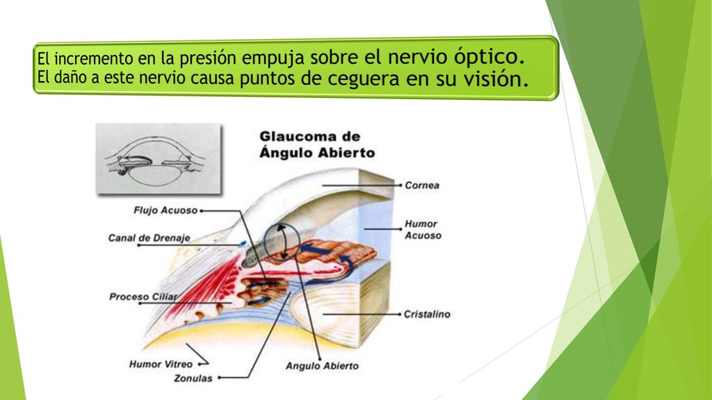 El incremento en la presión empuja sobre el nervio óptico