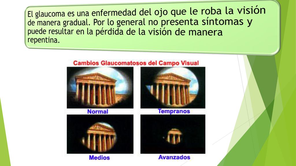El glaucoma es una enfermedad del ojo que le roba la visión de manera gradual.
