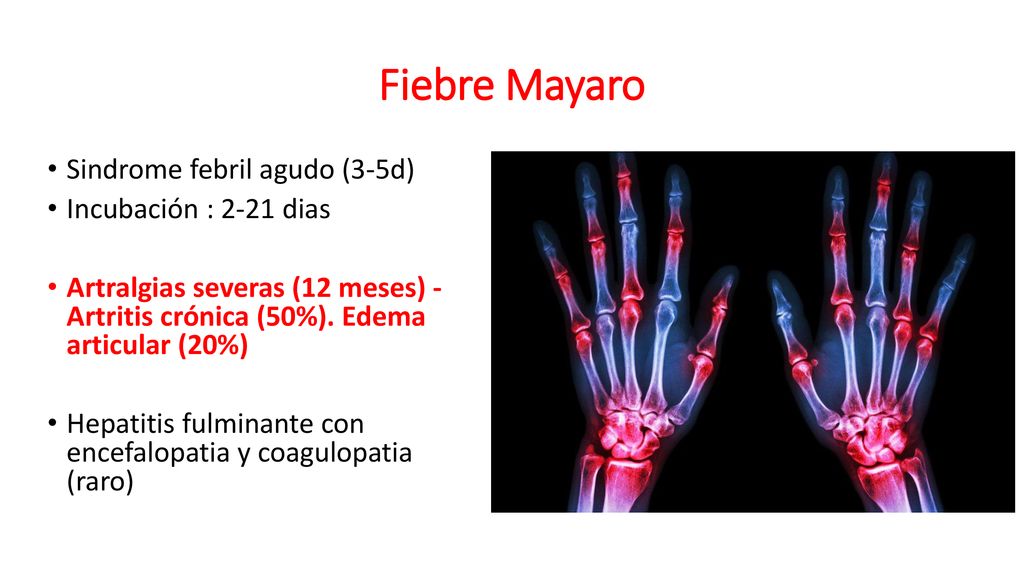 Fiebre Mayaro Sindrome febril agudo (3-5d) Incubación : 2-21 dias