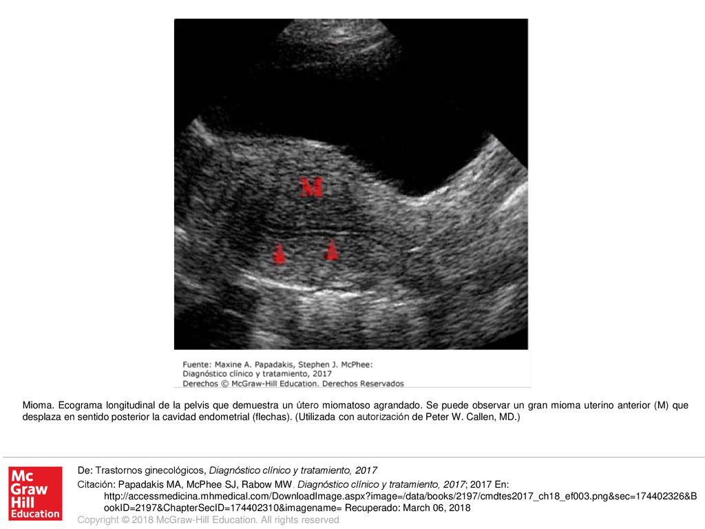 Mioma. Ecograma longitudinal de la pelvis que demuestra un útero miomatoso agrandado. Se puede observar un gran mioma uterino anterior (M) que desplaza en sentido posterior la cavidad endometrial (flechas). (Utilizada con autorización de Peter W. Callen, MD.)