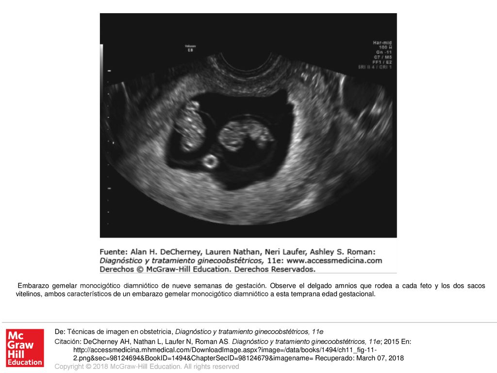 Embarazo gemelar monocigótico diamniótico de nueve semanas de gestación. Observe el delgado amnios que rodea a cada feto y los dos sacos vitelinos, ambos característicos de un embarazo gemelar monocigótico diamniótico a esta temprana edad gestacional.