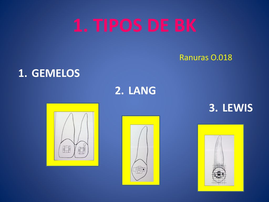 1. TIPOS DE BK GEMELOS LANG LEWIS Ranuras O.018