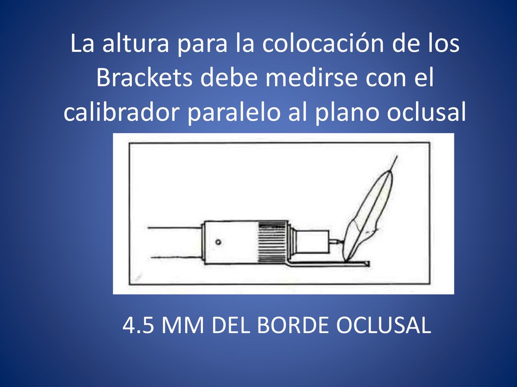 La altura para la colocación de los Brackets debe medirse con el calibrador paralelo al plano oclusal