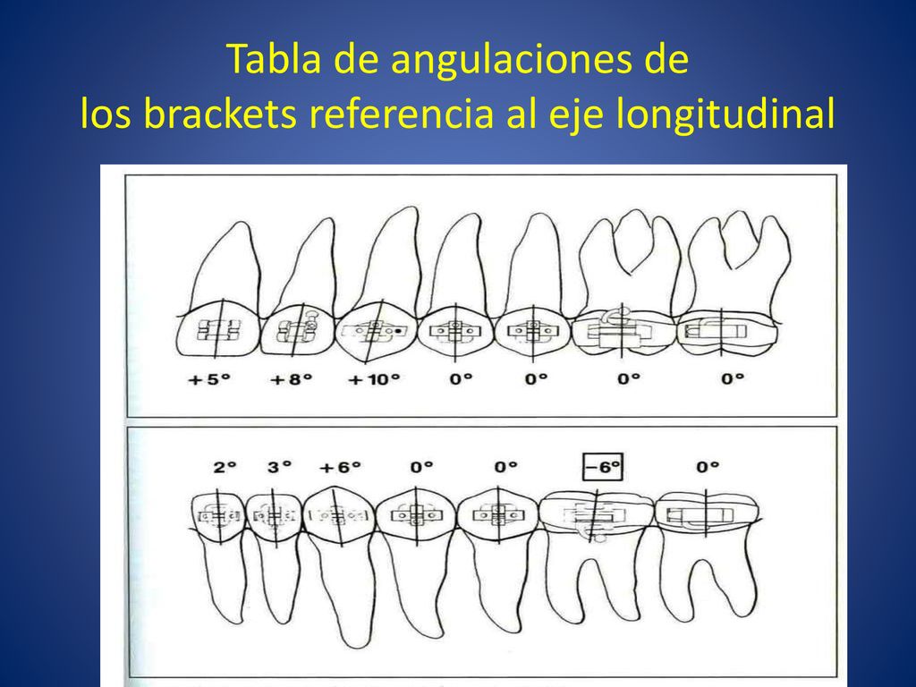 Tabla de angulaciones de los brackets referencia al eje longitudinal