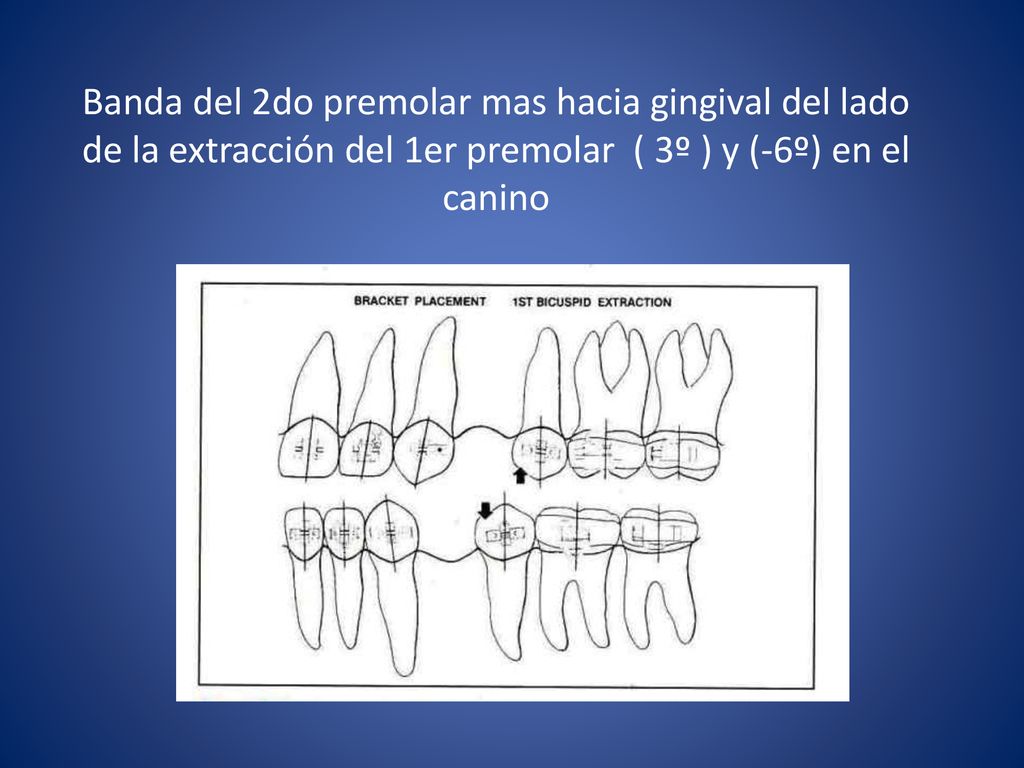 Banda del 2do premolar mas hacia gingival del lado de la extracción del 1er premolar ( 3º ) y (-6º) en el canino