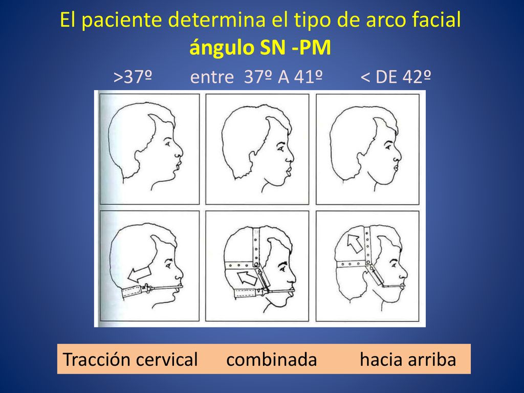 El paciente determina el tipo de arco facial ángulo SN -PM