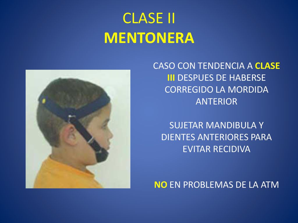 CLASE II MENTONERA CASO CON TENDENCIA A CLASE III DESPUES DE HABERSE CORREGIDO LA MORDIDA ANTERIOR.
