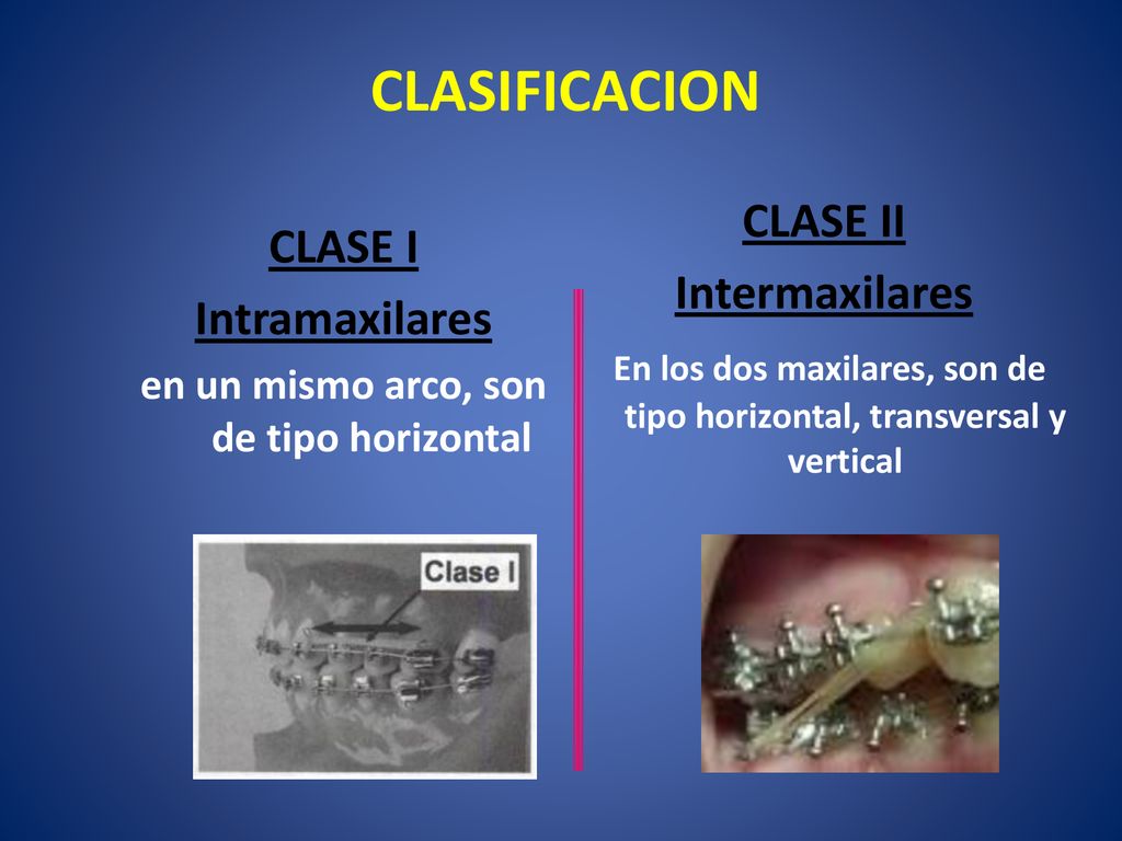 en un mismo arco, son de tipo horizontal