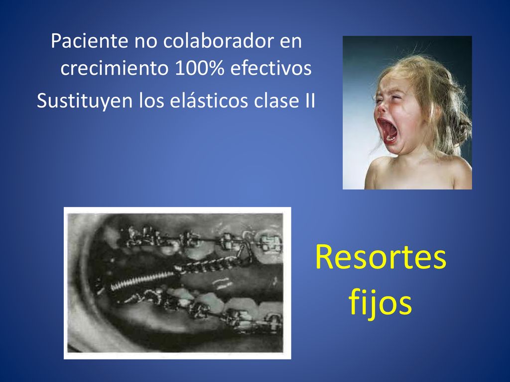 Paciente no colaborador en crecimiento 100% efectivos Sustituyen los elásticos clase II