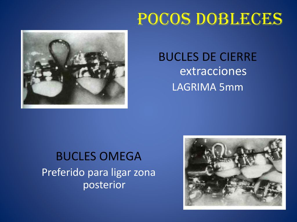 POCOS DOBLECES BUCLES DE CIERRE extracciones BUCLES OMEGA LAGRIMA 5mm