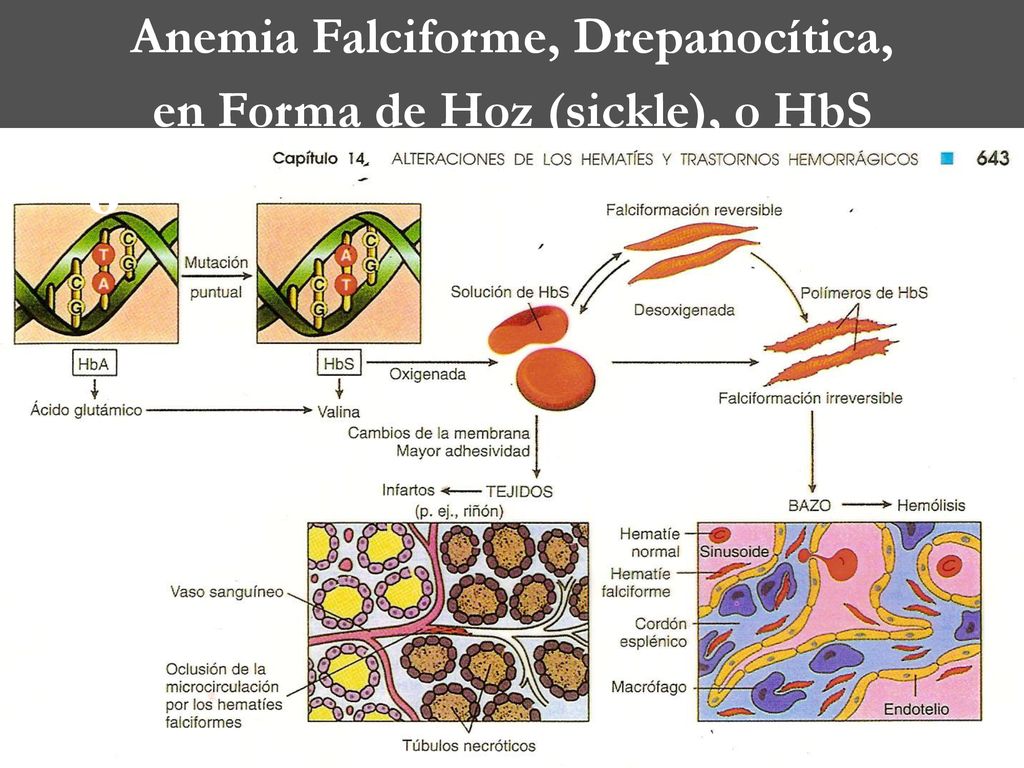 Anemia Falciforme, Drepanocítica, en Forma de Hoz (sickle), o HbS