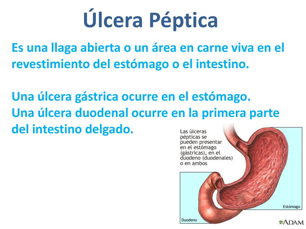 Úlcera Péptica Es una llaga abierta o un área en carne viva en el revestimiento del estómago o el intestino.