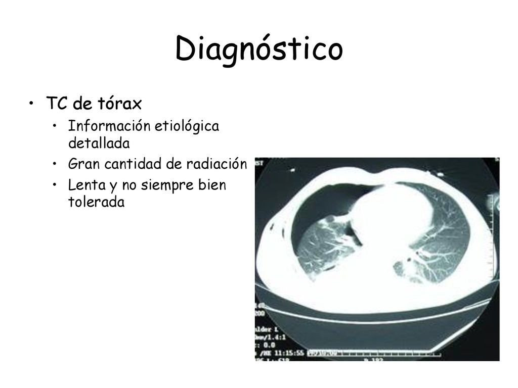 Diagnóstico TC de tórax Información etiológica detallada