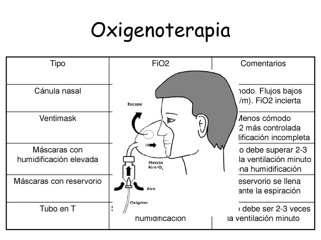 Oxigenoterapia Tipo FiO2 Comentarios Cánula nasal