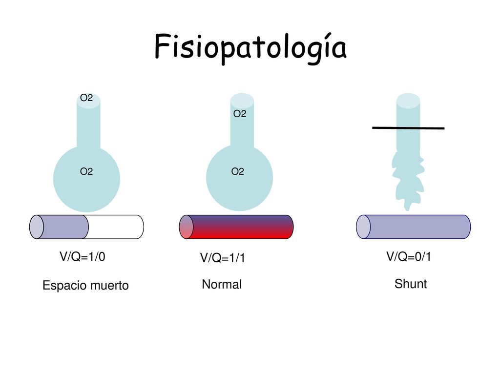 Fisiopatología V/Q=1/0 V/Q=1/1 V/Q=0/1 Espacio muerto Normal Shunt O2
