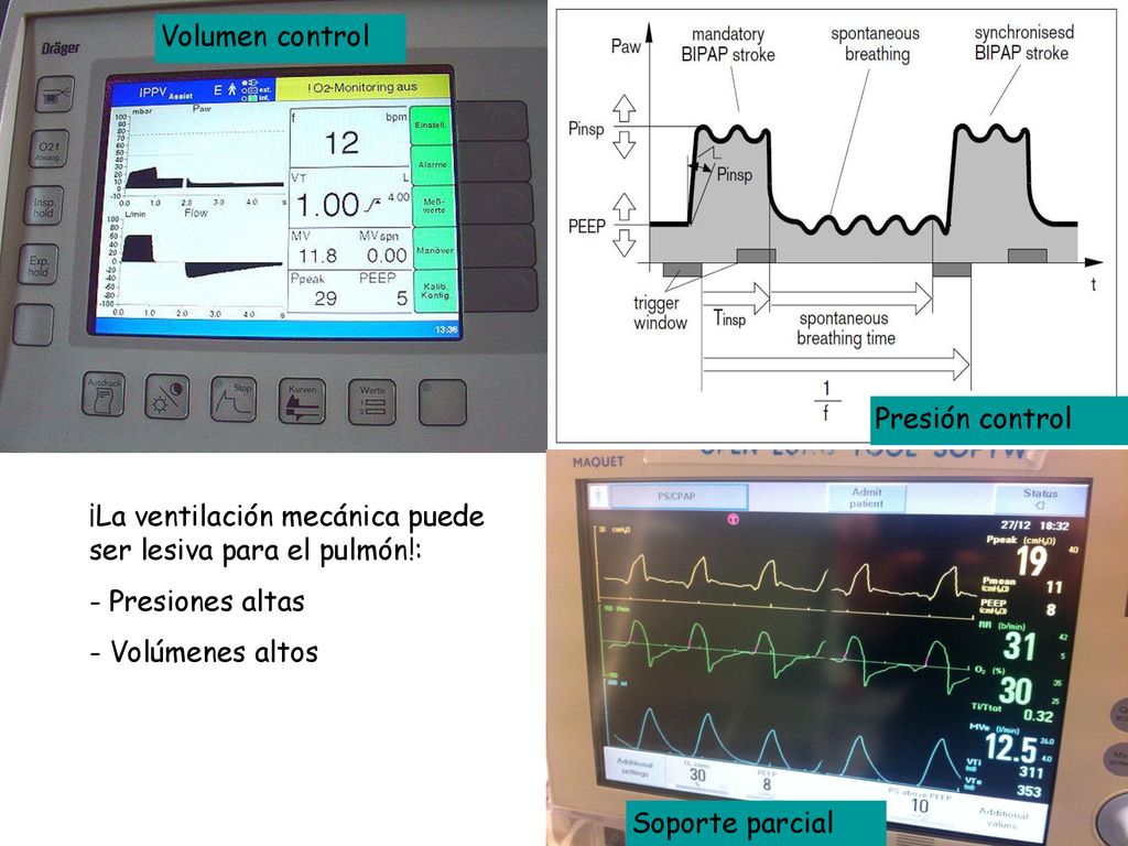 Volumen control Presión control. ¡La ventilación mecánica puede ser lesiva para el pulmón!: Presiones altas.