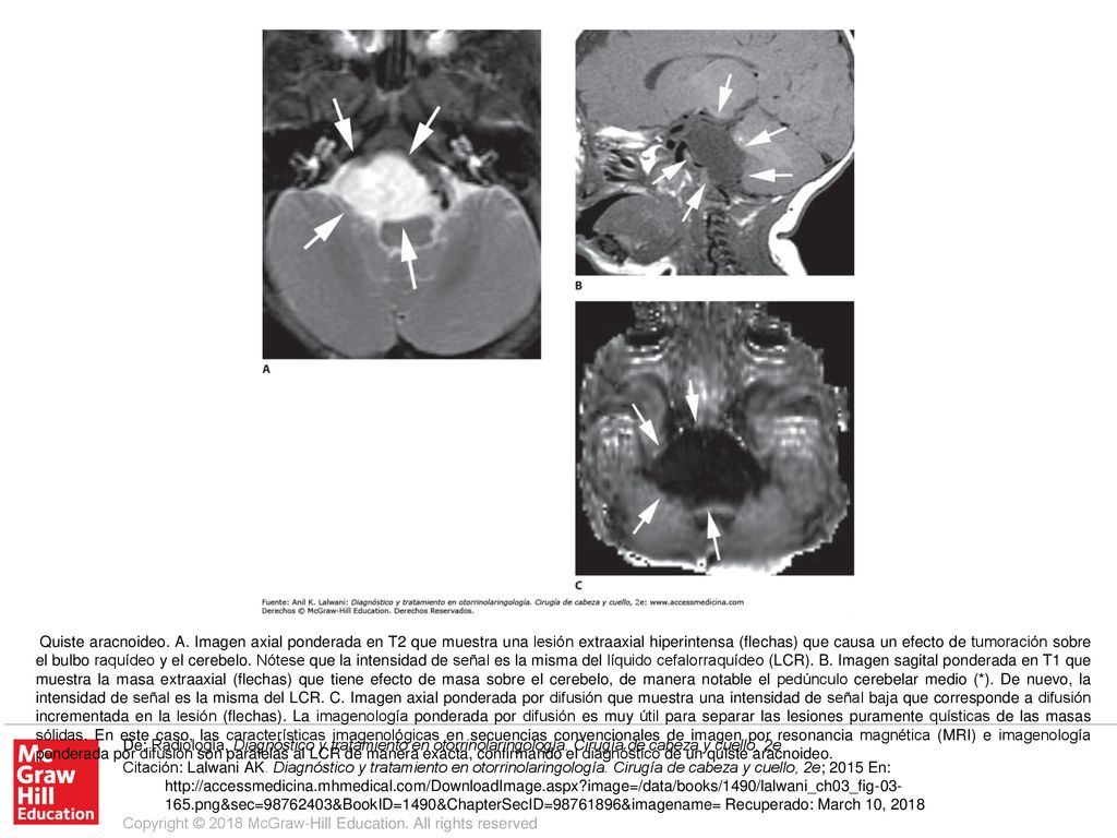 Quiste aracnoideo. A. Imagen axial ponderada en T2 que muestra una lesión extraaxial hiperintensa (flechas) que causa un efecto de tumoración sobre el bulbo raquídeo y el cerebelo. Nótese que la intensidad de señal es la misma del líquido cefalorraquídeo (LCR). B. Imagen sagital ponderada en T1 que muestra la masa extraaxial (flechas) que tiene efecto de masa sobre el cerebelo, de manera notable el pedúnculo cerebelar medio (*). De nuevo, la intensidad de señal es la misma del LCR. C. Imagen axial ponderada por difusión que muestra una intensidad de señal baja que corresponde a difusión incrementada en la lesión (flechas). La imagenología ponderada por difusión es muy útil para separar las lesiones puramente quísticas de las masas sólidas. En este caso, las características imagenológicas en secuencias convencionales de imagen por resonancia magnética (MRI) e imagenología ponderada por difusión son paralelas al LCR de manera exacta, confirmando el diagnóstico de un quiste aracnoideo.
