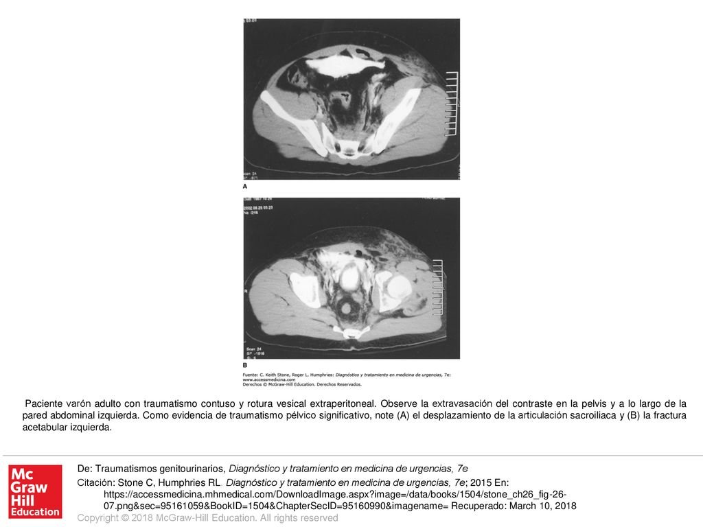 Paciente varón adulto con traumatismo contuso y rotura vesical extraperitoneal. Observe la extravasación del contraste en la pelvis y a lo largo de la pared abdominal izquierda. Como evidencia de traumatismo pélvico significativo, note (A) el desplazamiento de la articulación sacroiliaca y (B) la fractura acetabular izquierda.